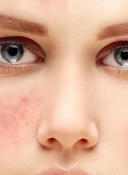 Acne and Scarring featured image
