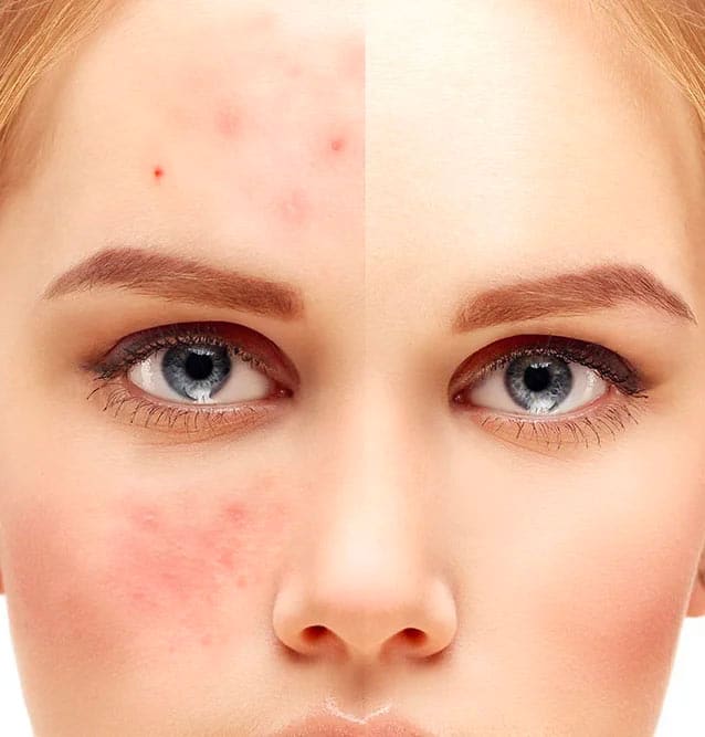 acne treatments before & after