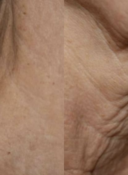 CO2 LASER wrinkle removal featured image