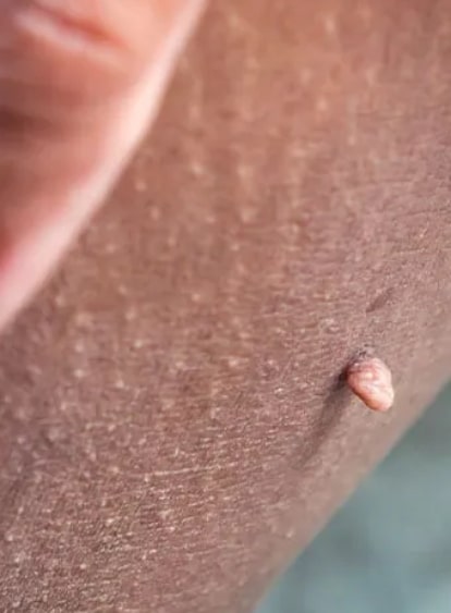Skin Tags featured image