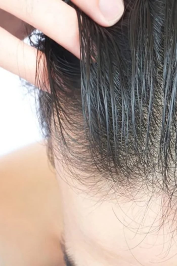 PRP Therapy hair loss blog image
