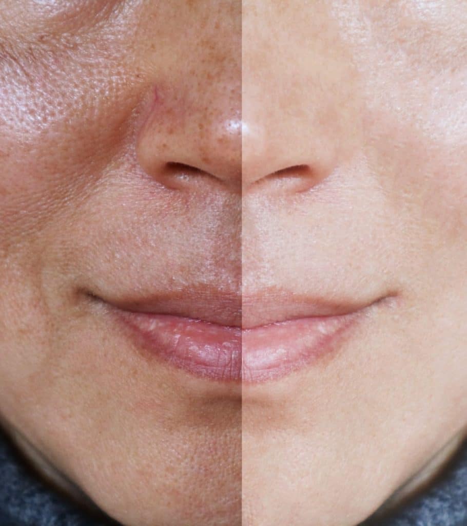 cosmelan treatment before & after